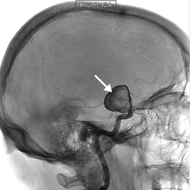 Diagnosis Stroke Mayo Clinic